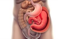 sakit perut sebelah kiri