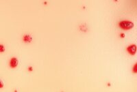 jenis penyakit kulit