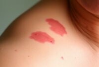 bercak-merah-pada-kulit bercak merah pada kulit